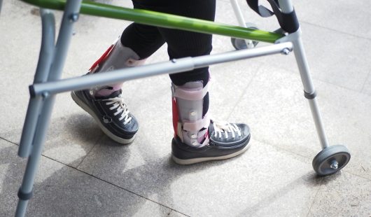 Broken Leg Claims Broken Leg Claims