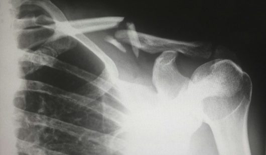 Broken or Fractured Bone Claims Broken or Fractured Bone Claims