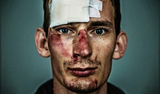 Face Injury Claims Face Injury Claims