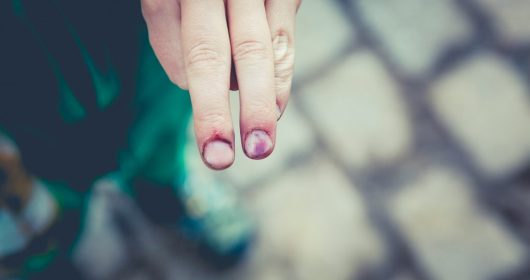 Non-Freezing Cold Injury – NFCI